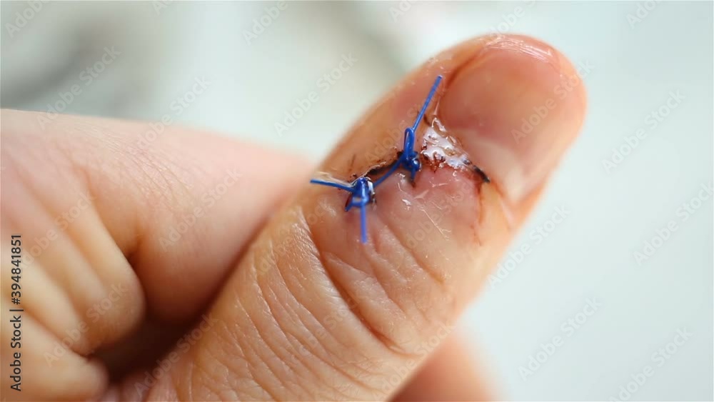A clear, flowing antiseptic liquid drips onto the incised, healed wound and surgical sutures. Extreme close-up, real time, natural light, contains people, medicine A clear, flowing antiseptic liquid drips onto the incised, healed wound and surgical sutures. Extreme close-up, real time, natural light, contains people, medicine