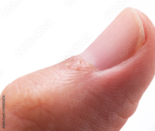 A close-up of a hangnail on a white background photo