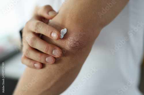 Photography Man applying protective cream to damaged skin of elbow close-up