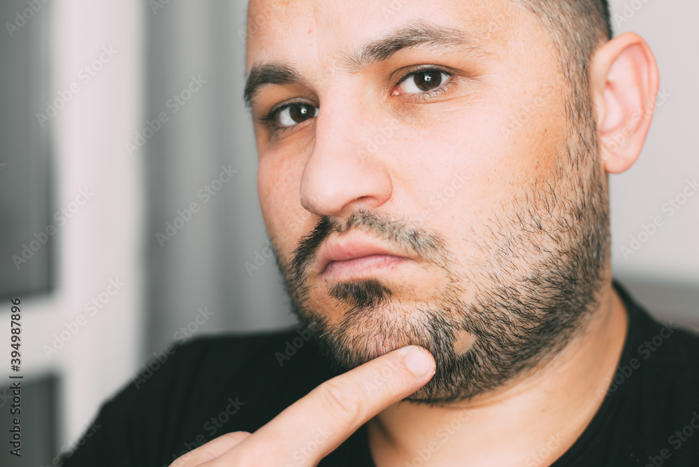 Fototapeta premium Alopecia areata on a man beard. Receding, face