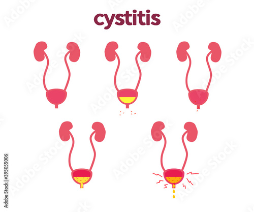 Bladder on a white background. Cystitis. Vector illustration.