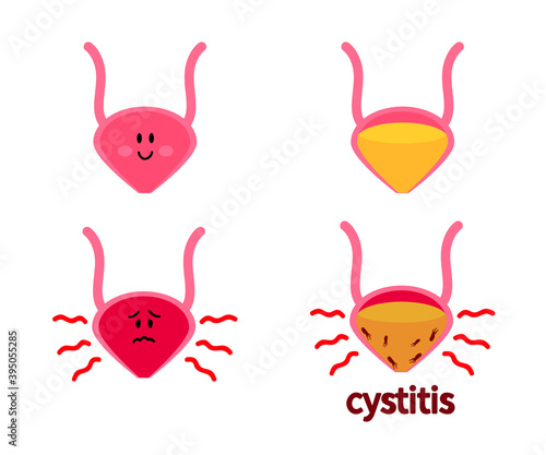 Bladder on a white background. Cystitis. Vector illustration.