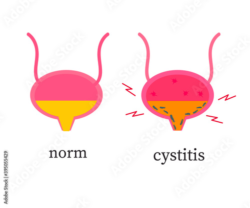 Bladder on a white background. Cystitis. Vector illustration.