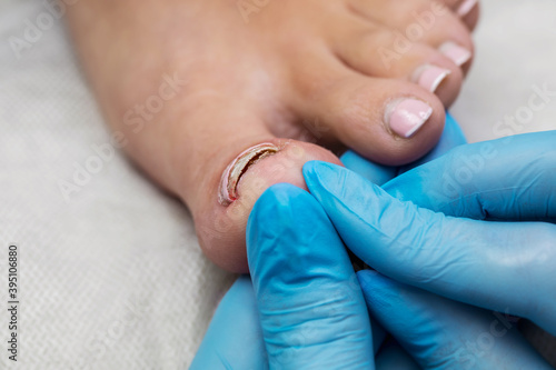 The master in the salon examines the client's feet before the pedicure. Fungus on the toenails. The problem of onycholysis on the nails. photo