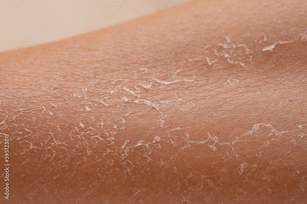 Sunburns of body, closeup. Skin damaged by sun, peeling. Body care theme Sunburns of body, closeup. Skin damaged by sun, peeling. Body care theme