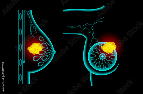 Breast disease concept