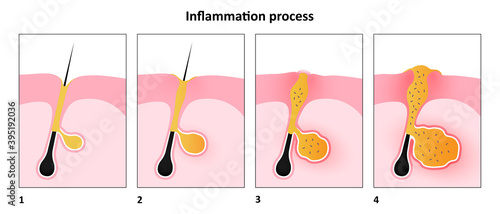 Inflammation process of acne, Stage of human skin acne