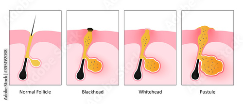 Types of acne, Inflammatory problems on the skin