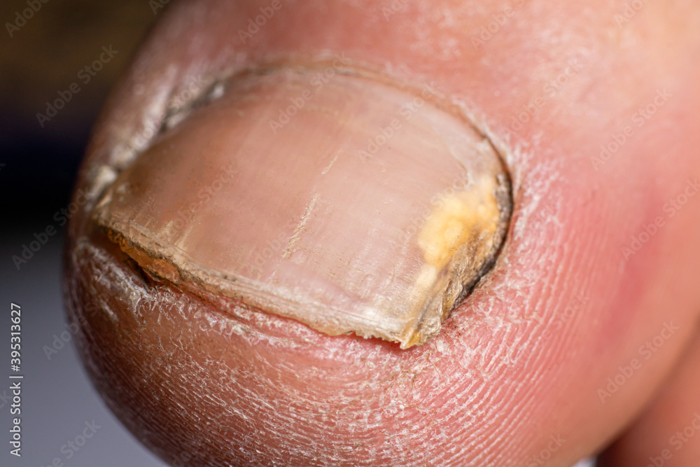Fungus of nails on the big toe - dermatomycosis and onychomycosis, fungal infection macro photo. Dermatology, treatment of nail mycosis. Fungus of nails on the big toe - dermatomycosis and onychomycosis, fungal infection macro photo. Dermatology, treatment of nail mycosis.