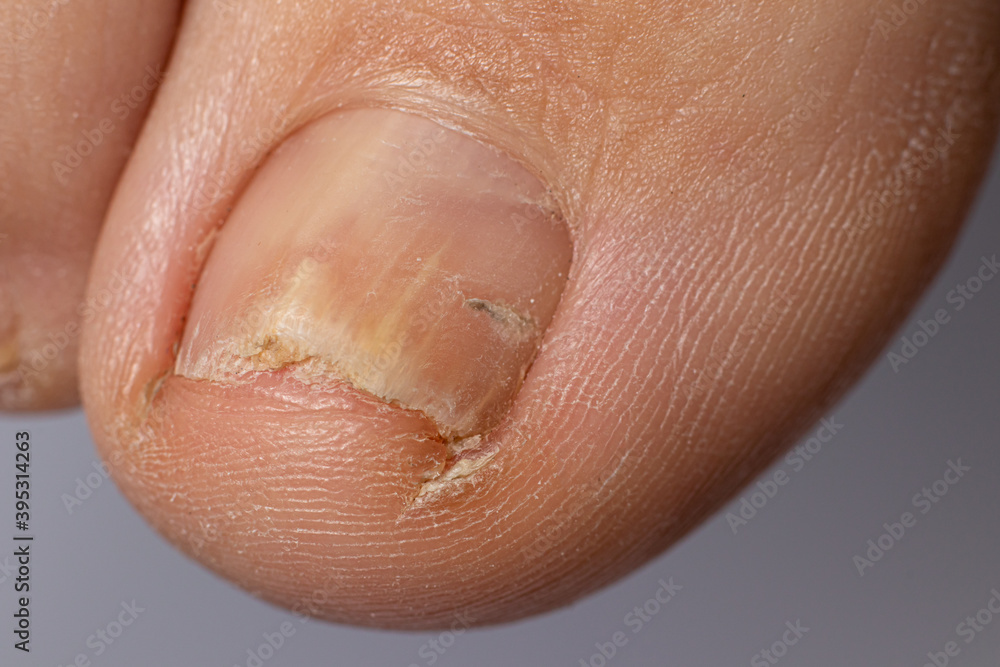 Fungal Nails - Gray Foot and Orthotic Clinic