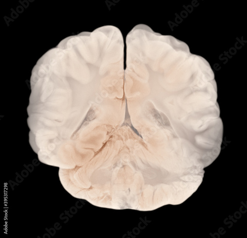Vertical Section Through Cerebral Hemispheres. Human Brain Anatomy