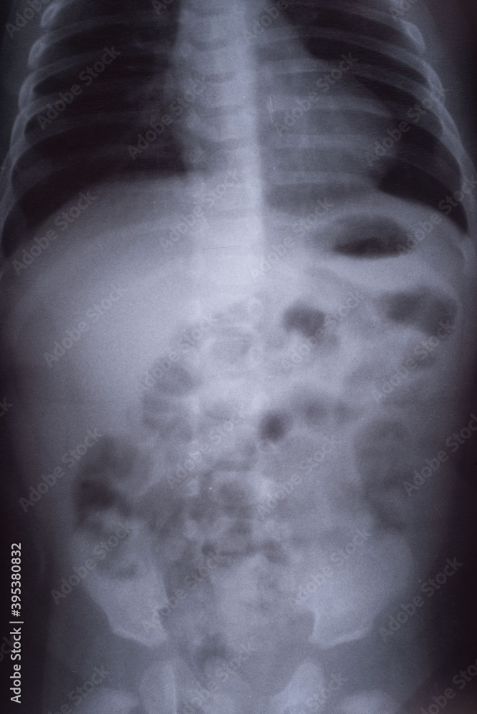 intestinal obstruction in a child x ray Stock Photo Adobe Stock