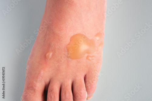 Burn Blisters on a Man's Foot cause by boiling water accident.  It's an above view and isolated on a gray background.