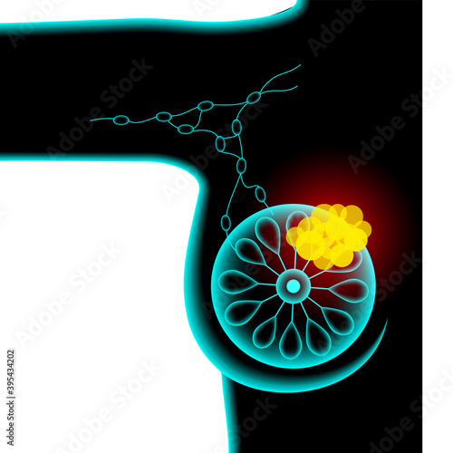 Breast disease concept