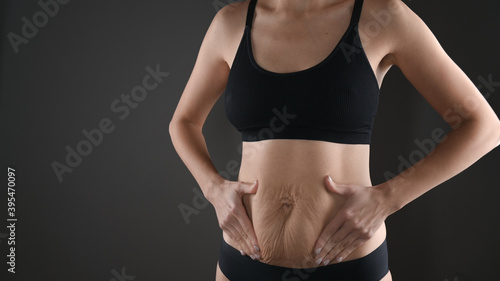 Woman showing stretch mark loose lower abdomen skin. Fat belly after pregnancy baby birth.Tummy tuck, flabby skin on a fat belly, plastic surgery concept