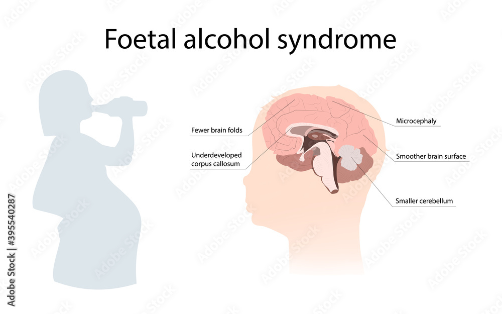 Illustration showing the effects of foetal alcohol syndrome on the brain. With explanations. Drinking pregnant woman.