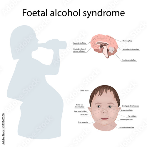 Illustration showing the effects of foetal alcohol syndrome on the brain and on a child's face. With explanations. Drinking pregnant woman.