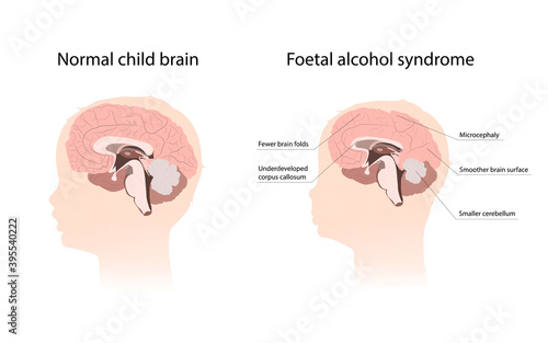 Illustration showing the effects of foetal alcohol syndrome on the brain. With explanations. Comparison with normal healthy