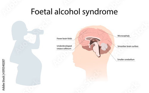 Illustration showing the effects of foetal alcohol syndrome on the brain. With explanations. Drinking pregnant woman.