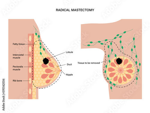 Breast disease concept