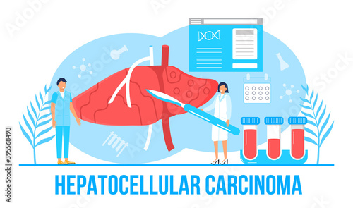 Hepatocellular carcinoma concept vector. Hepatitis A, B, C, D, cirrhosis, world hepatitis day. Tiny doctors treat liver