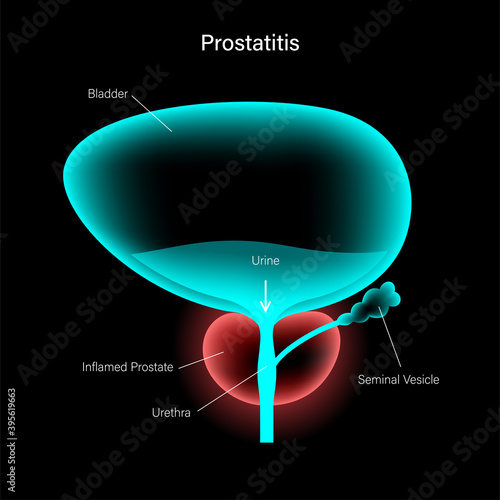 Prostatitis inflammation problem