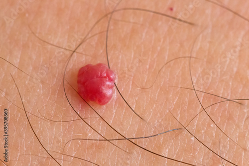 Senile angioma closeup macro view over caucasian skin