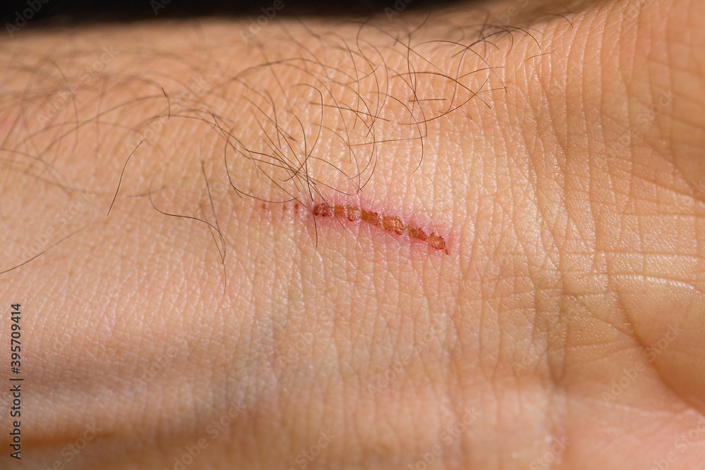 Scab over internal side of wrist closeup Scab over internal side of wrist closeup