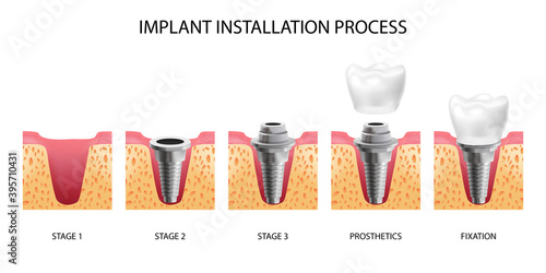 Implant Installation Stages