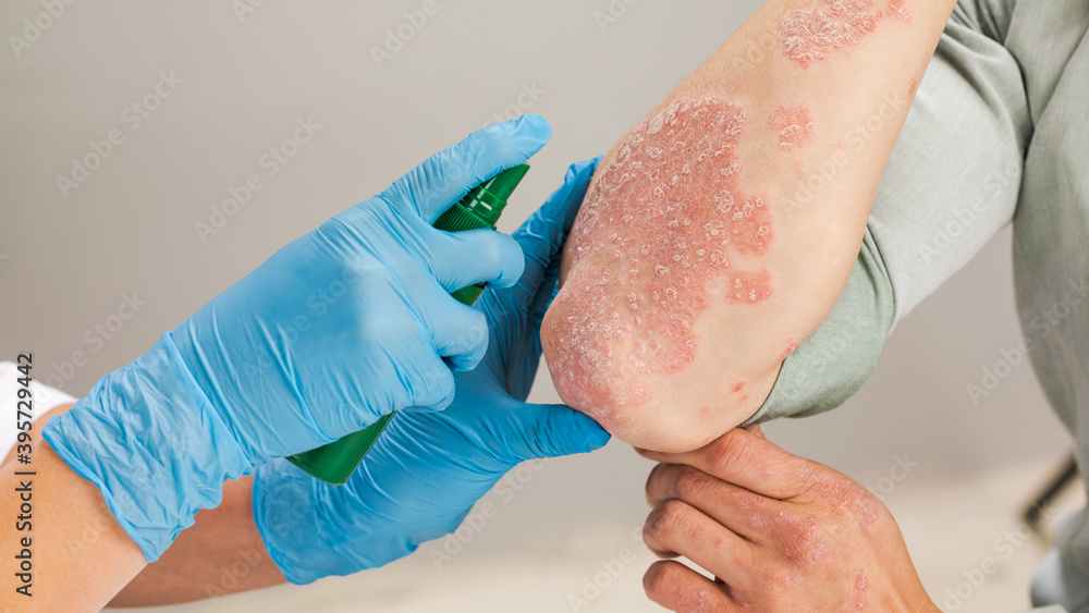 Dermatologist wearing gloves to apply medicine to the skin of a sick