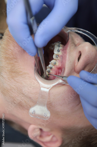 Correction of teeth of a person with an incorrect bite. The installation of braces. Tweezers in the hands of an orthodontist. Vertical photo. Extender for the mouth .
