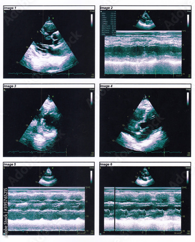 фотографія An echocardiography in 2d and M-Mode (TTE)