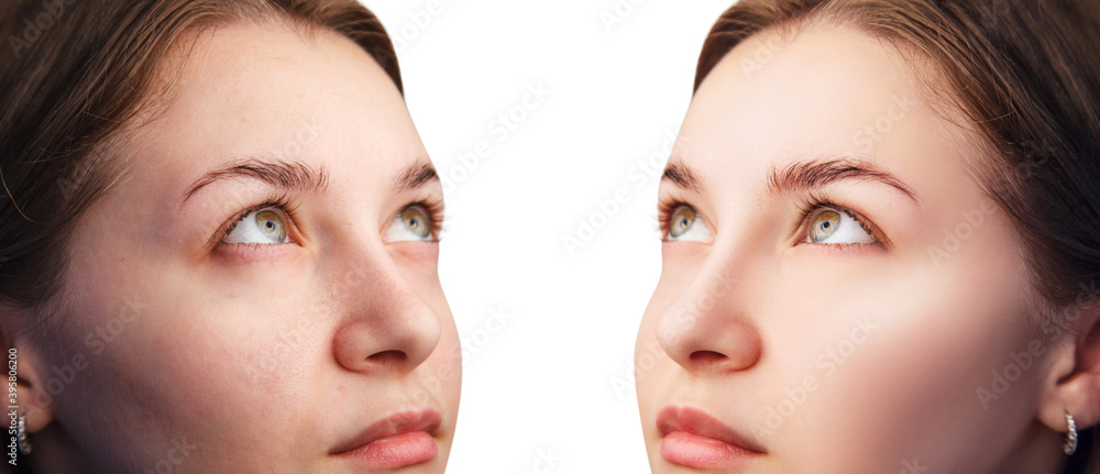 Face of beautiful woman before and after skin retouch. Beautician concept. Face of beautiful woman before and after skin retouch. Beautician concept.
