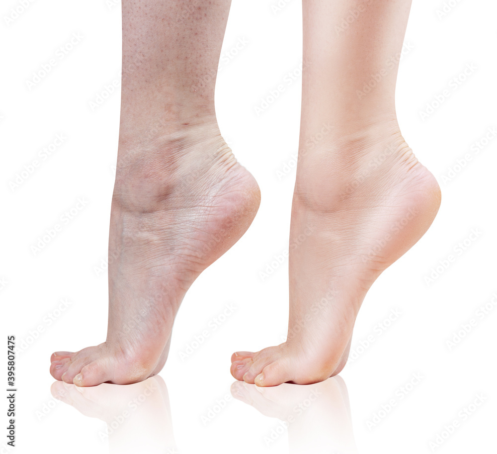 Female feet with dry skin before and after treatment or retouch. Over white background. Female feet with dry skin before and after treatment or retouch. Over white background.