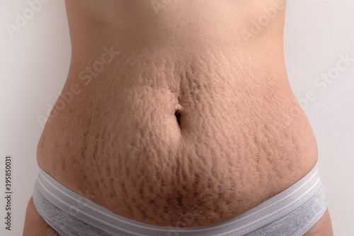 female belly with stretch marks