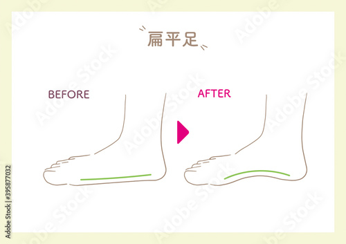 Acupoints on the soles of the feet_3