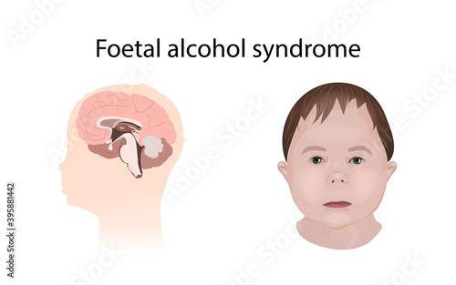 Illustration showing the effects of foetal alcohol syndrome on the brain and on a child's face.
