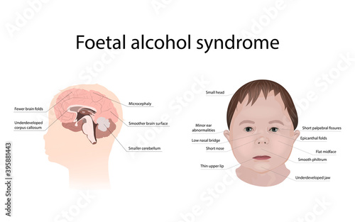 Tableau sur toile Illustration showing the effects of foetal alcohol syndrome on the brain and on a child's face