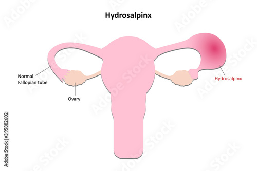 Hydrosalpinx diagram, Obstructed Follopian tube