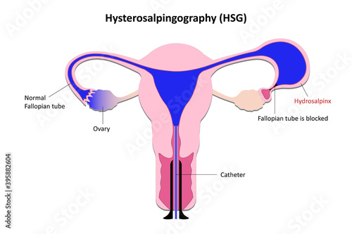 Hysterosalpingography, Radiological eamination of the uterine cavity and uterus