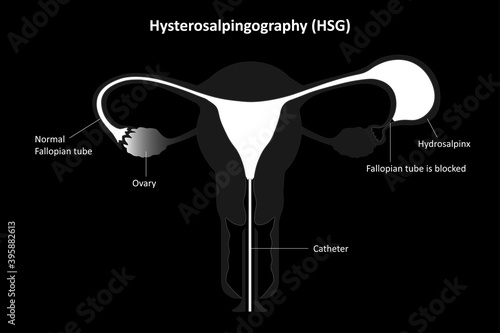 Hysterosalpingography, Radiological eamination of the uterine cavity and uterus