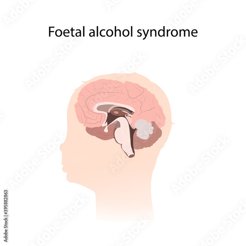 Illustration showing the effects of foetal alcohol syndrome on the brain.