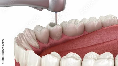 Endodontic root canal treatment process. Medically accurate tooth 3D animation photo