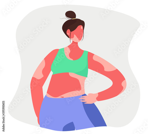 Cartoon Vector illustration of Vitiligo Woman.White Pigment Autoimmune Disease with Pigment Loss.Skin Depigmentation and Genetic Illness.Body Positive.Skin Disease and Pimples.Vector Illustration