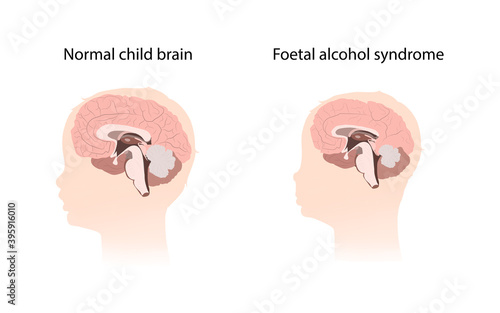 Illustration showing the effects of foetal alcohol syndrome on the brain. Comparison with normal healthy