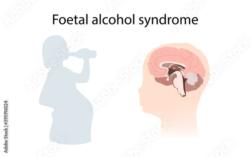 Illustration showing the effects of foetal alcohol syndrome on the brain. Drinking pregnant woman.