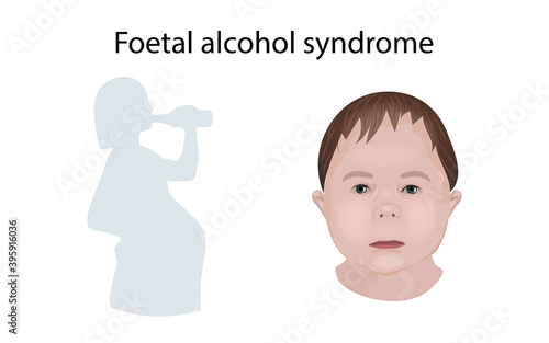 Illustration showing the effects of foetal alcohol syndrome on a child's face. Drinking pregnant woman.