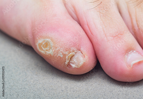 Large dry callus on the little toe of a man's foot. Consequences of wearing uncomfortable, tight shoes. photo