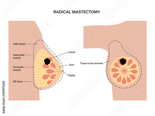 Breast disease concept