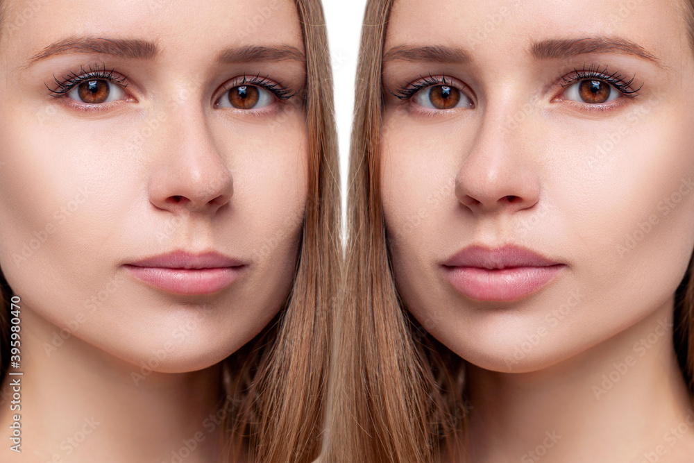 Beautiful female lips before anf after augmentation procedure. Over white background.